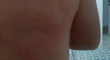 Elazığ'da böcek ısırığı hastanelik etti