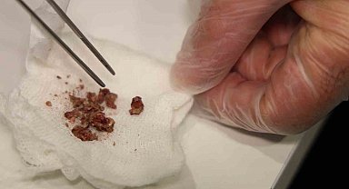 Elazığ'da estetik ameliyatta şaşırtan olay, burundan taş çıktı